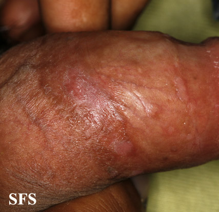 Bowenoid papulosis. Adapted from Dermatology Atlas.[3]