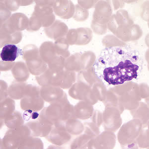 Leishmania (Viannia) panamensis amastigotes in a Giemsa-stained tissue scraping. Adapted from CDC