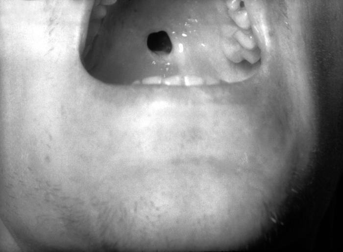 This photograph depicts a perforated hard palate on a patient with congenital syphilis. This patient with congenital syphilis has developed a perforation of hard palate due to gummatous destruction. These destructive tumors can also attack the skin, long bones, eyes, mucous membranes, throat, liver, or stomach lining. Adapted from CDC