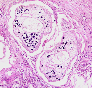 Proliferating spargana in groin tissue of a patient from Paraguay, stained with hematoxylin and eosin (H&E). Adapted from CDC
