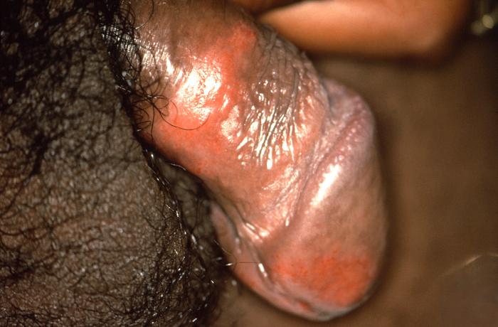 This patient presented with what was differentially diagnosed as a herpes genitalis outbreak on the penile glans and shaft. Note that what at first appears as erythematous areas are actually coalescence of herpes genitalis “micro-ulcers”. Genital herpes is a sexually transmitted disease (STD) caused by the herpes simplex viruses type 1 (HSV-1) and type 2 (HSV-2). Adapted from CDC
