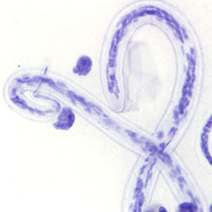 Microfilaria of L. loa a thick blood smear from a patient from Cameroon, stained with Giemsa. Note the nuclei extending to the tip of the tail to the left of the image. Adapted from CDC