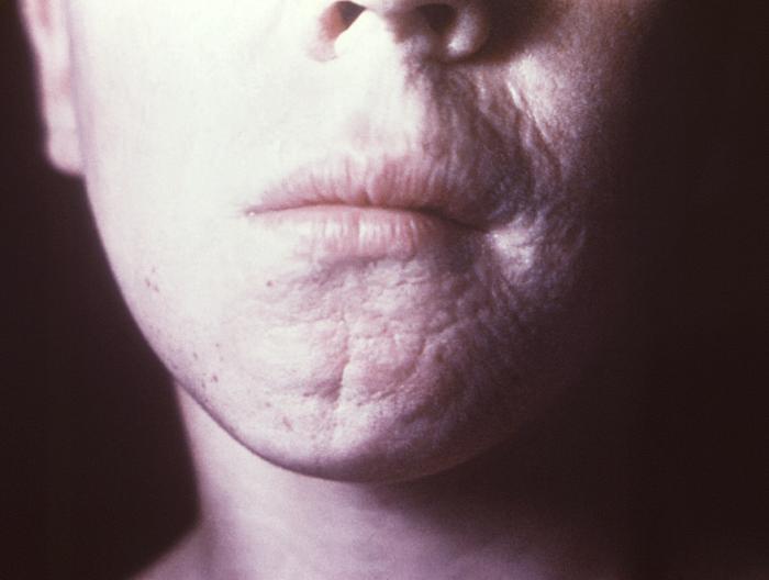 This photograph depicts the wrinkled skin around a patient’s nose and mouth known as “rhagades”, due to a congenital syphilitic infection. Congenital syphilis, is a condition caused by infection in utero with Treponema pallidum. A wide spectrum of severity exists, and only severe cases are clinically apparent at birth. An infant or child (aged less than 2 years) may have signs such as hepatosplenomegaly, rash, condyloma lata, snuffles, jaundice (nonviral hepatitis), pseudoparalysis, anemia, or edema (nephrotic syndrome and/or malnutrition). An older child may have stigmata (e.g., interstitial keratitis, nerve deafness, anterior bowing of shins, frontal bossing, mulberry molars, Hutchinson teeth, saddle nose, rhagades, or Clutton joints). Adapted from CDC