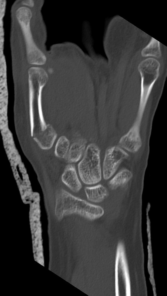 There is a transverse fracture through the proximal metaphyseal region of the fifth metacarpal bone with lateral angulation and no intra-articular extension. The carpal bones are intact, no evidence of scaphoid fractures. Soft tissue swelling and carpal joint effusion noted.