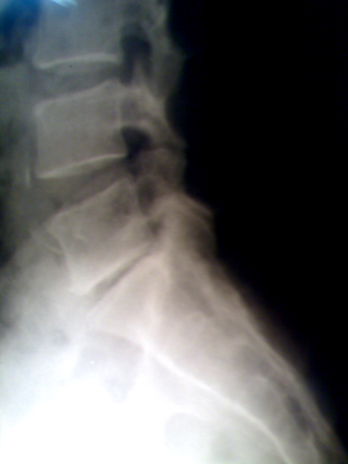 Spinal disc herniation - wikidoc