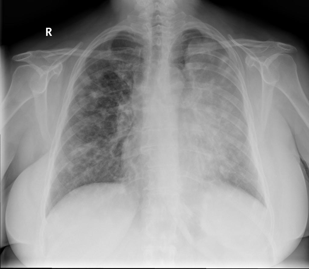 Luftsichel sign: curvilinear opacity at the left apex represents compensatory hyperinflation of the left lower lobe. Case courtesy of A.Prof Frank Gaillard. Source: Radiopaedia.org[4]
