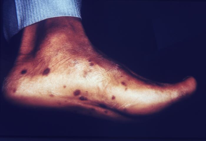 This patient presented with secondary papular syphilids on the soles of his feet. The second stage starts when one or more areas of the skin break into a rash that appears as rough, red or reddish brown spots both on the palms of the hands and on the bottoms of the feet. Even without treatment, rashes clear up on their own. Adapted from CDC