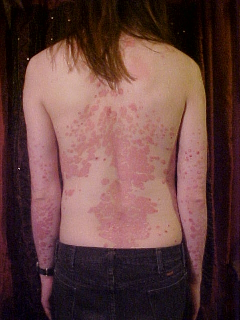 A young man with psoriasis involving back and arms, source:wikipedia.org