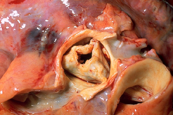Aorta and coronary arteries at autopsy. The proximal portion of the RCA and its ostium can be seen at the lower left.