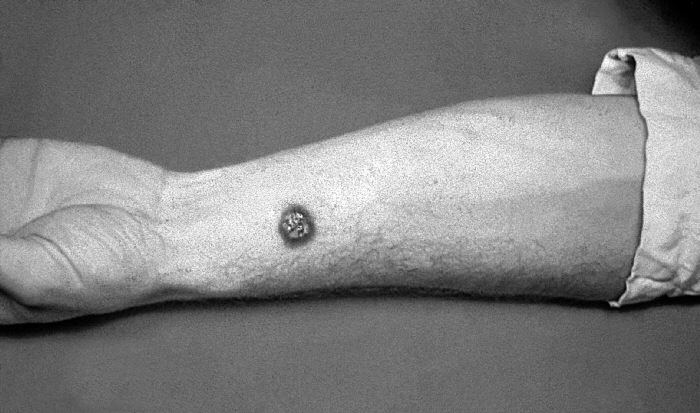 "Anthrax, skin of left forearm”Adapted from Public Health Image Library (PHIL), Centers for Disease Control and Prevention.[20]