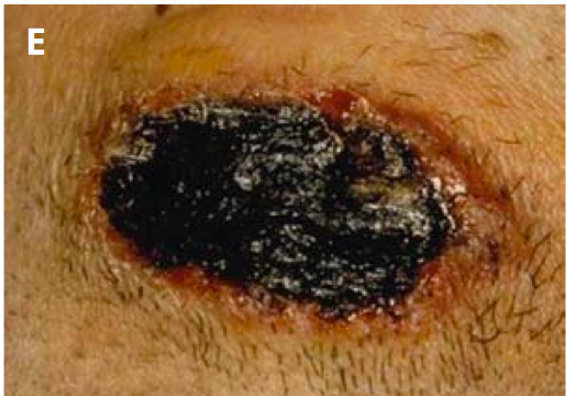 Day 11 of development and resolution of uncomplicated cutaneous anthrax lesion.”Adapted from World Health Organization (WHO)[1]