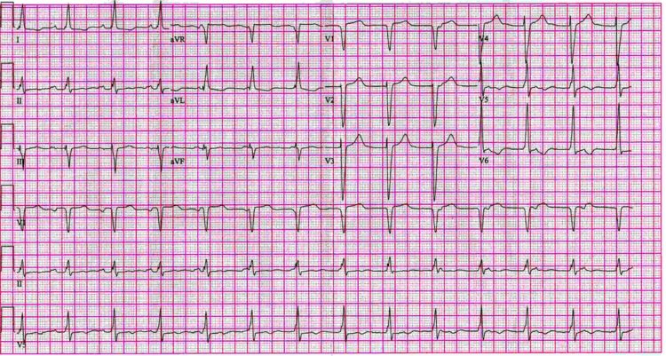 12 lead EKG: AV junctional rhythm with Atrioventricular dissociation