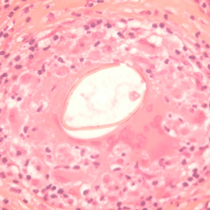Longitudinal section of an egg of P. kellicotti in a lung biopsy specimen, stained with hematoxylin and eosin (H&E). Image courtesy of Dr. Gary Procop. Adapted from CDC