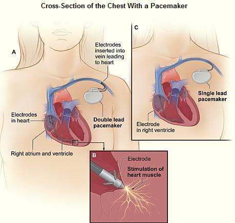 Illustration of implanted pacemakers