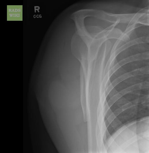 Anterior shoulder dislocation: Post-reduction