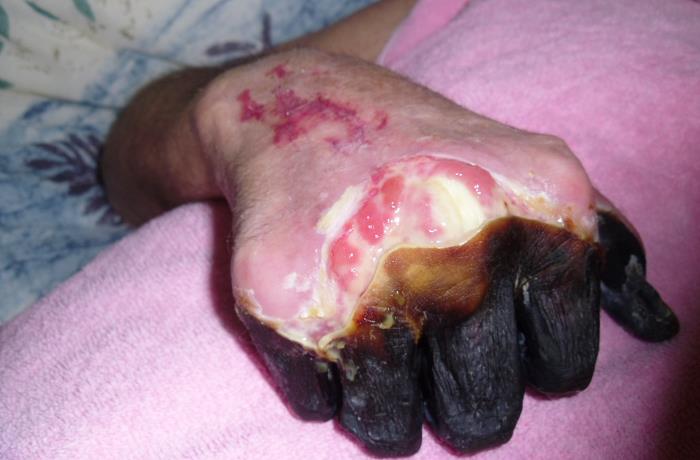 Dorsal view of a 59 year-old man’s right hand who had been infected by the plague bacterium, Yersinia pestis, after having come into contact with both an infected cat, and a dead mouse in his neighborhood. Adapted from Public Health Image Library (PHIL), Centers for Disease Control and Prevention.[15]
