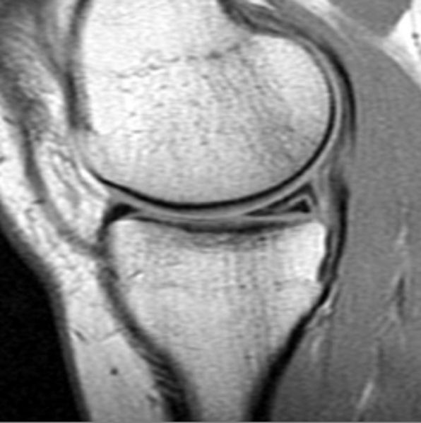File:Tear-posterior-horn-medial-meniscus-003.jpg