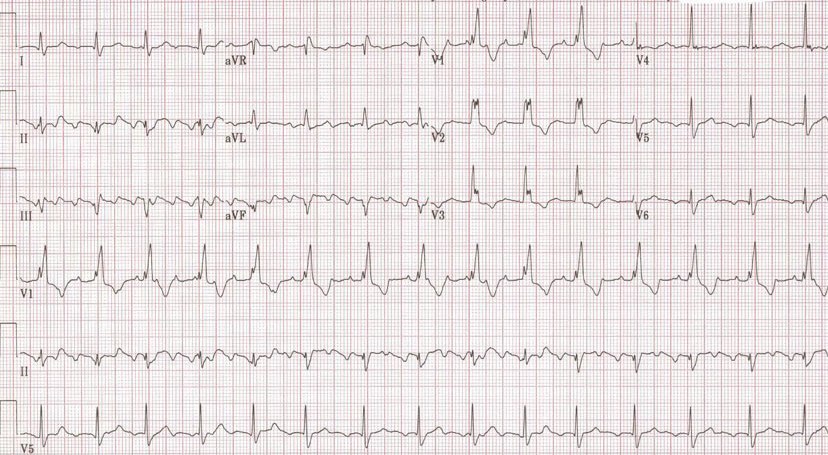 Atrial flutter with RBBB