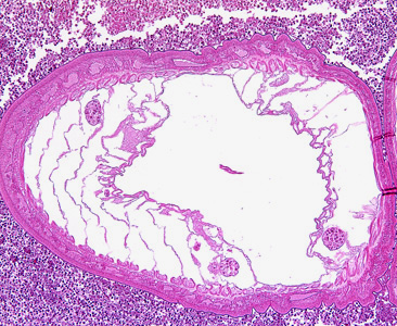 Transverse section through the body wall of Bolbosoma sp. in an intestinal biopsy specimen, stained with H&E. Image taken at 100x magnification. Cetaceans are the normal definitive hosts for Bolbosoma spp., and humans usually become infected after eating under-cooked fish which serve as paratenic hosts for the parasite. Adapted from CDC