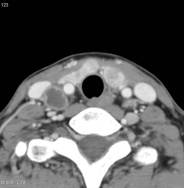 Papillary thyroid cancer CT - wikidoc