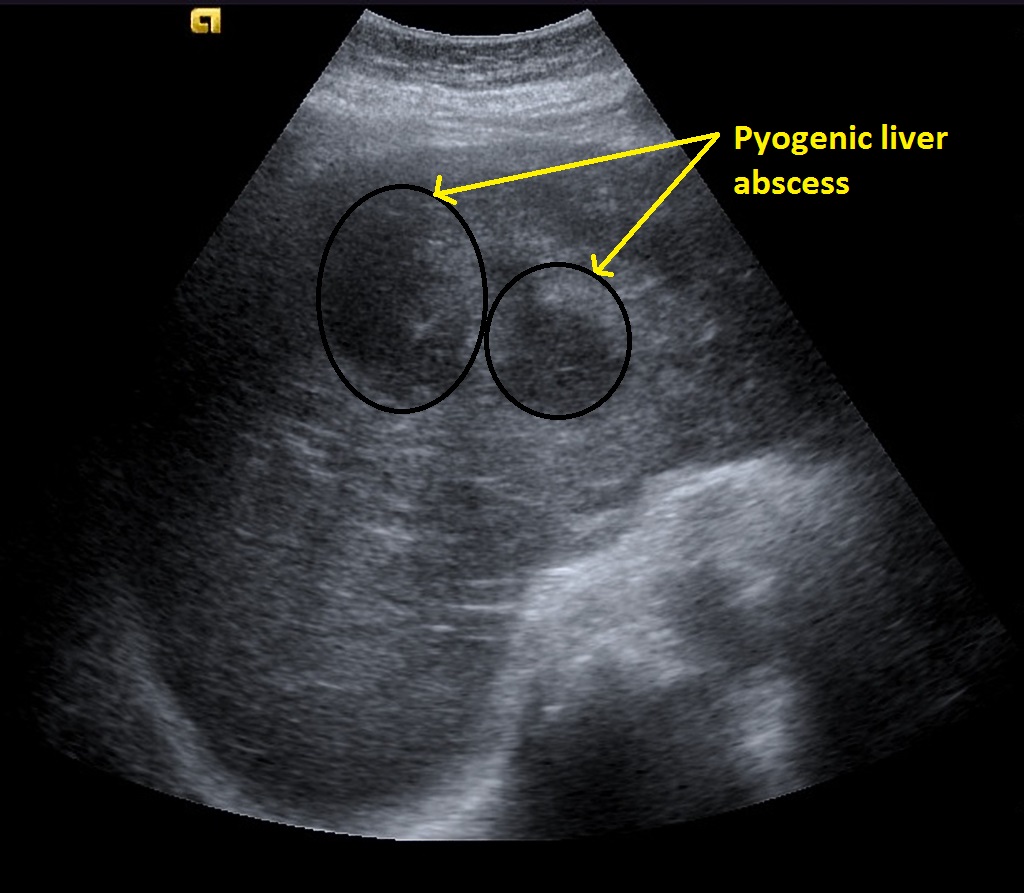 File:Pyogenic-hepatic-abscess-contrast-enhanced-ultrasound (4).jpg