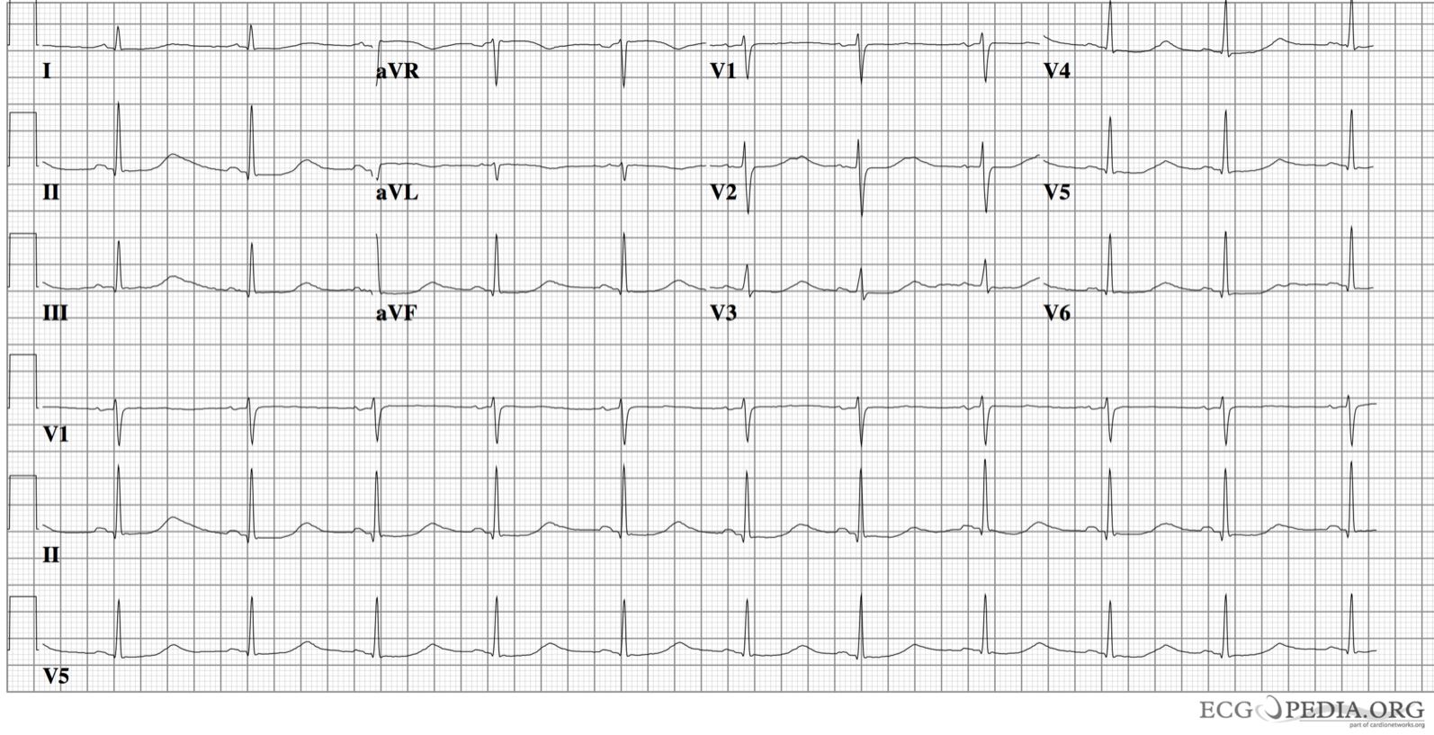 Prolonged QT Interval seen in Long QT Syndrome