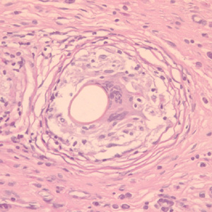 Cross-section of an egg of P. kellicotti in a lung biopsy specimen, stained with periodic acid-Schiff (PAS) stain. Image courtesy of Dr. Gary Procop. Adapted from CDC