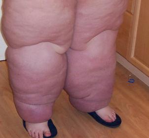 Stage 3 lymphedema front view before treatments