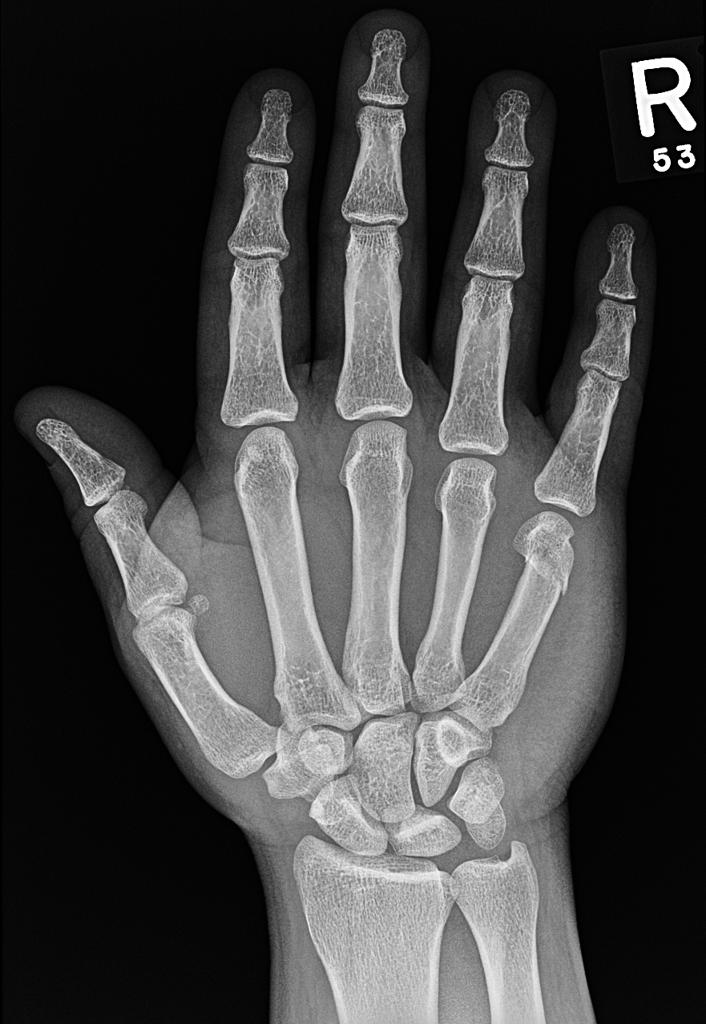 File:Boxer-fracture-12.jpg