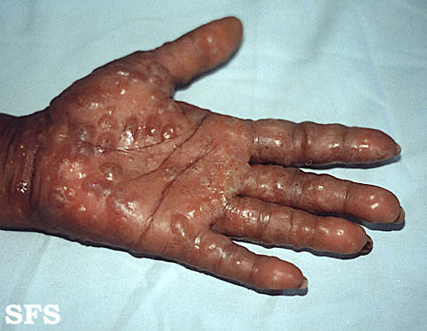 File:Dyshidrotic eczema02.jpg