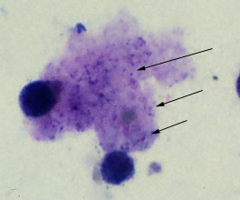 Trophozoites of P. jirovecii in a bronchoalveolar lavage (BAL) specimen from an AIDS patient, stained with Giemsa. Adapted from CDC