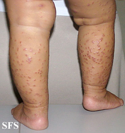 Papular acrodermatitis of childhood - RightDiagnosis.com