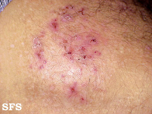 File:Dermatitis herpetiformis03.jpg