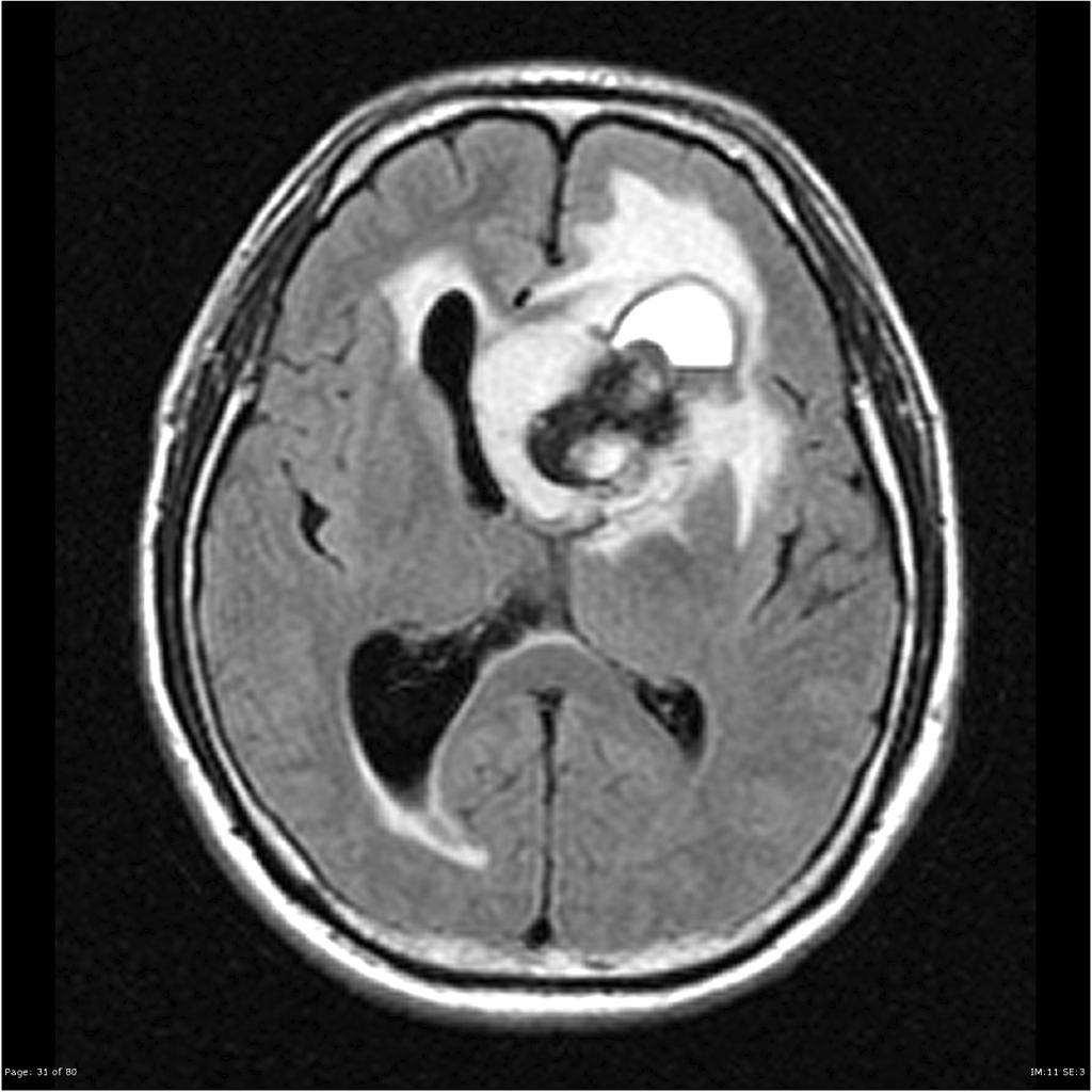 File:Ependymoma-lateral-ventricle(5).jpg