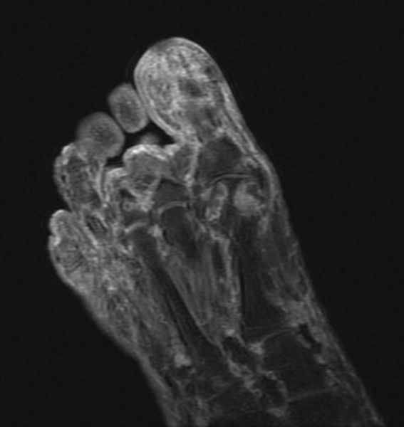 File:Gout MRI 003.jpg