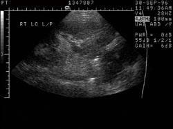 File:Renal artery stenosis 006.jpg
