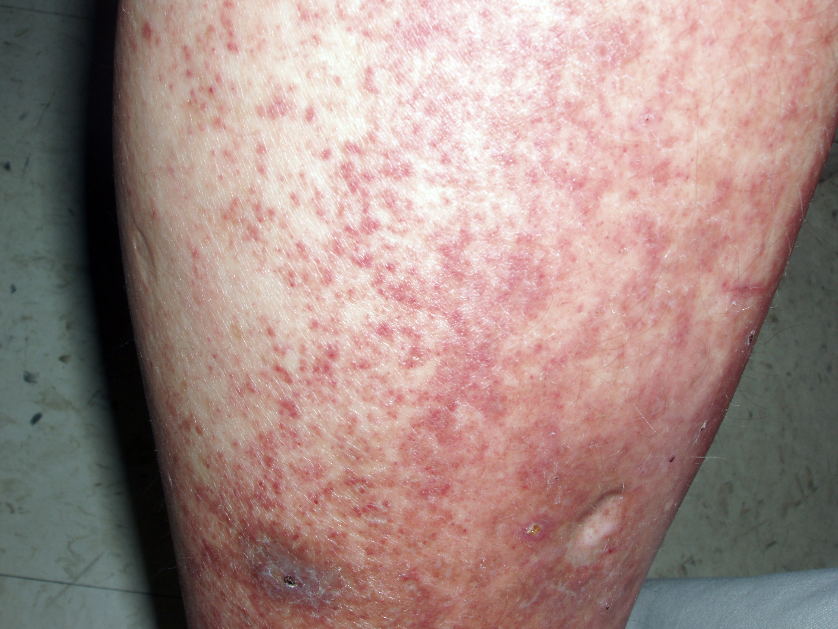 Vasculitis: In this instance, idiopathic with palpable purpura.