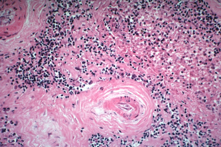 Spleen: Lupus erythematosus. Basophilic bodies and periarterial fibrosis: Micro high mag, H&E. Two basophilic bodies and periarterial fibrosis. An excellent example of this rarely seen lupus lesion.