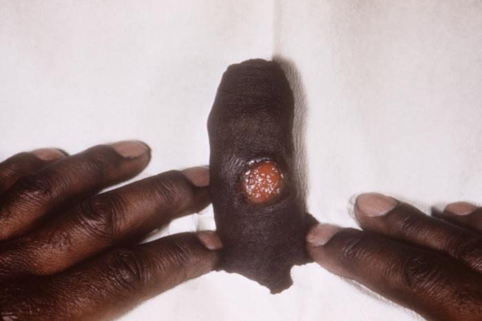 This photograph shows a penile chancre due to his primary syphilitic infection caused by Treponema pallidum bacteria. The primary stage of syphilis is usually marked by the appearance of a sore called a chancre. The chancre is usually firm, round, small, and painless. It appears at the spot where syphilis entered the body, and lasts 3-6 weeks, healing on its own. Adapted from CDC