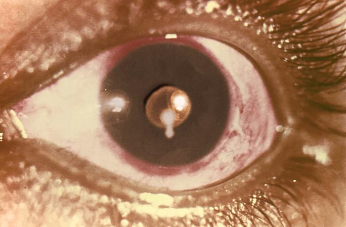 Presence of a cysticercus, the larval form of the Taenia solium pork tapeworm in the pupil of this patient’s left eye. Although rare, cysticerci may float in the eye and cause blurry or disturbed vision. Infection in the eyes may cause swelling or detachment of the retina. From Public Health Image Library (PHIL). [2]