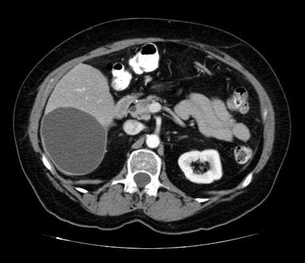 CT image demonstates a biliary cystadenoma