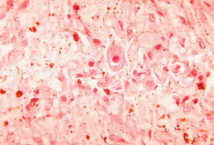Immunofluorescent technique of a specimen of human embryonic lung reveals the presence of cytomegalovirus (25X Mag). From Public Health Image Library (PHIL). [1]