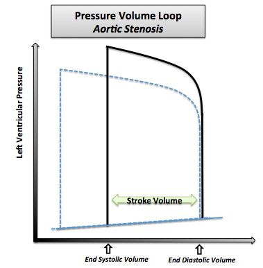 File:Pressure Volume Loop Aortic Stenosis.png