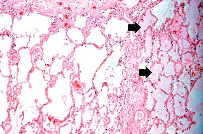 This is a higher-power photomicrograph showing edema-filled alveoli in the right portion of this section (arrows).