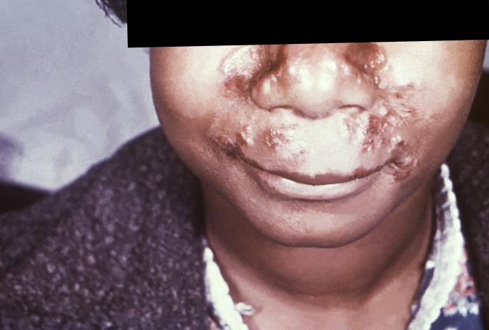 This photograph depicts a patient’s face revealing pathologic cutaneous changes in the region around the nose and mouth, consisting of noduloulcerative lesions, known as syphilids, due to a syphilitic infection. The secondary stage of syphilis is characterized by the manifestation of a skin rash and mucous membrane lesions. This stage typically starts with the development of a rash on one or more areas of the body. The rash usually does not cause itching. Rashes associated with secondary syphilis can appear as the chancre is healing or several weeks after the chancre has healed. The characteristic rash of secondary syphilis may appear as rough, red, or reddish brown spots both on the palms of the hands and the bottoms of the feet. However, rashes with a different appearance may occur on other parts of the body, sometimes resembling rashes caused by other diseases. Sometimes rashes associated with secondary syphilis are so faint that they are not noticed. In addition to rashes, symptoms of secondary syphilis may include fever, swollen lymph glands, sore throat, patchy hair loss, headaches, weight loss, muscle aches, and fatigue. The signs and symptoms of secondary syphilis will resolve with or without treatment, but without treatment, the infection will progress to the latent and possibly late stages of disease. Adapted from CDC