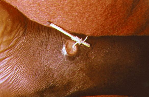 Image depicts a method used to extract a Guinea worm from the leg vein of a human patient. From Public Health Image Library (PHIL). [8]