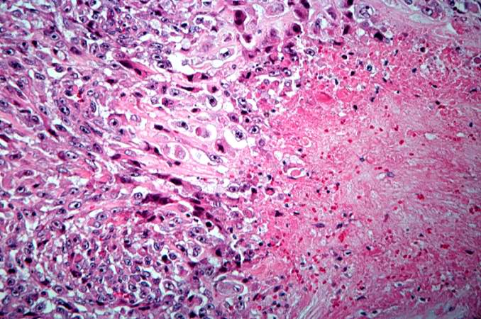 This is a high-power photomicrograph of the tumor demonstrating the anaplastic cell morphology.