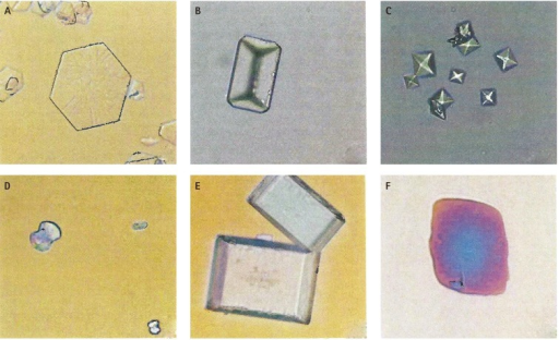 Type of stones. Light microscopy of urine crystals. (A) Hexagonal cystine crystal (200X); (B) coffin-lid shaped struvite crystals (200X); (C) pyramid-shaped calcium oxalate dehydrate crystals (200X); (D) dumbbell-shaped calcium oxalate monohydrate crystal (400X); (E) rectangular uric acid crystals (400X); and (F) rhomboidal uric acid crystals (400X).[16]