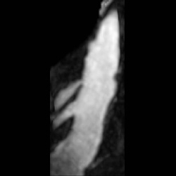 File:Renal artery stenosis 023.jpg