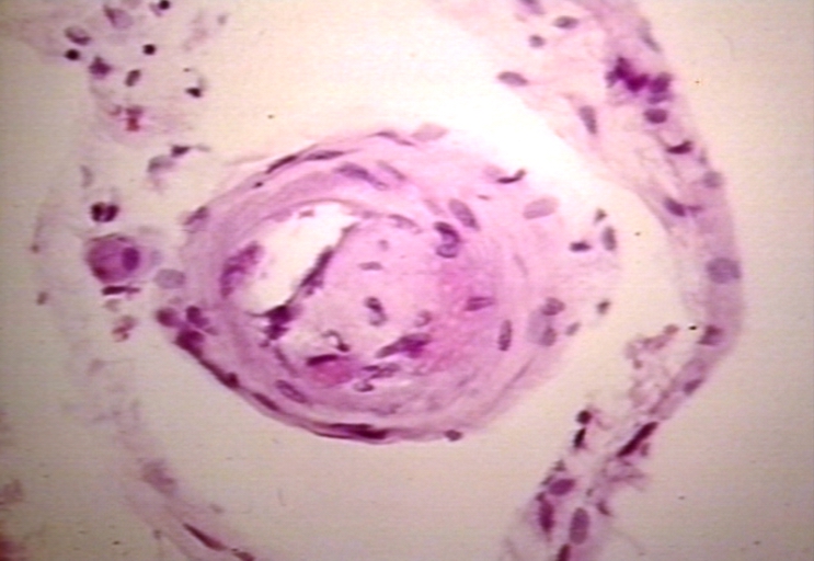Vessel: lupus, systemic erythematosus; Thrombus in capillary